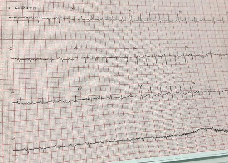eletrocardio