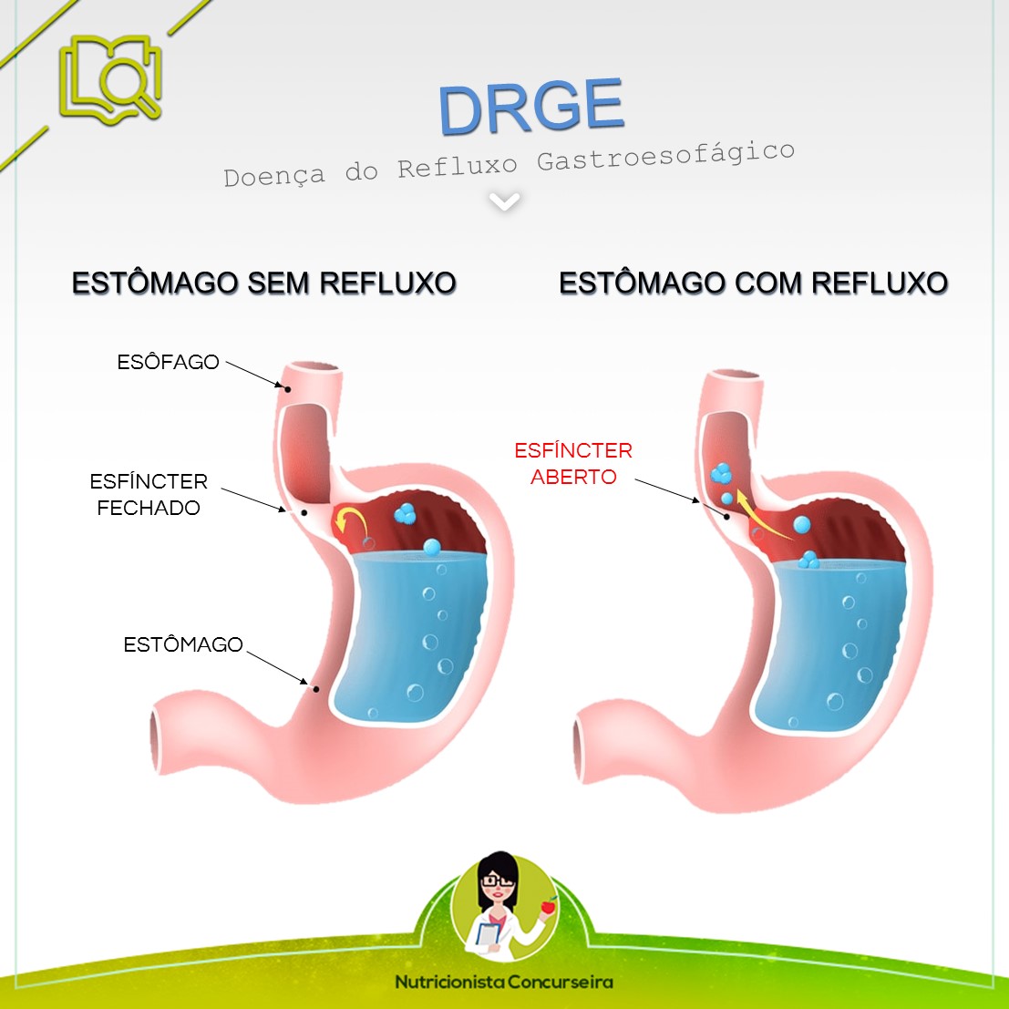 Com Sintomas De Azia E Refluxo Gastroesofágico Sergio Nao Consegue