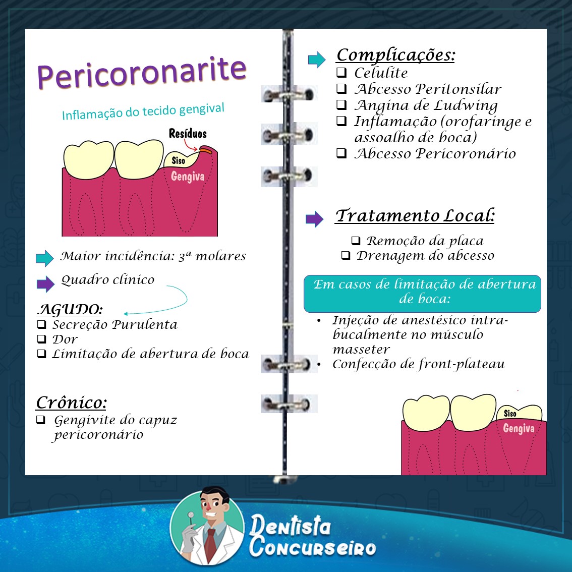 Resumo de Pericoronarite Odontologia Sanar Saúde